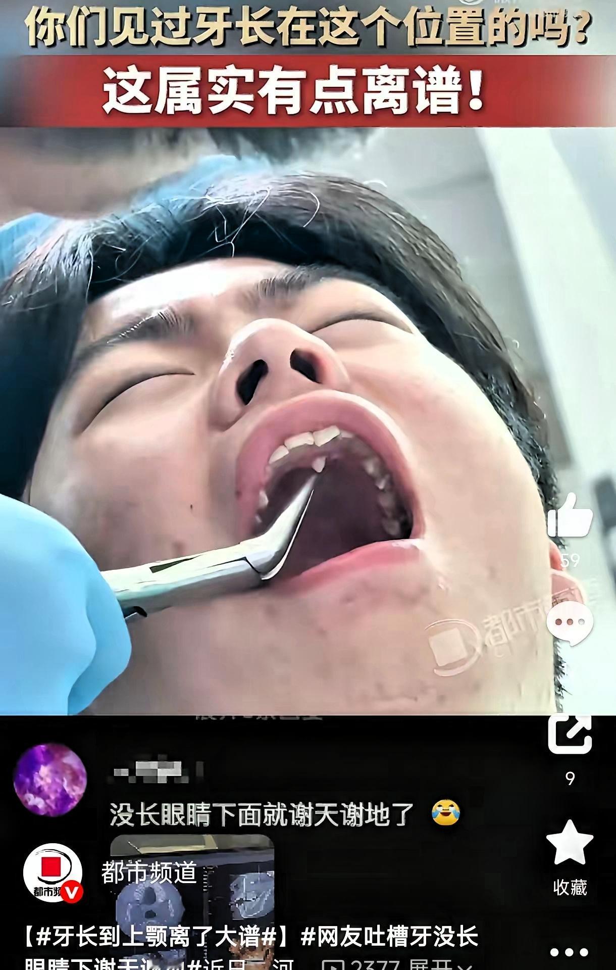 笑不活了！河北，一小伙因为牙疼去牙科拔牙，结果医生检查时发现，他的牙齿竟然长在了
