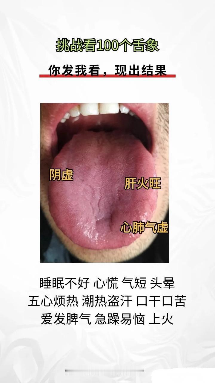 注意拍摄清晰，看的才更准确！
下面这3个舌象很常见：
1.心肺气虚，肝火旺
2.