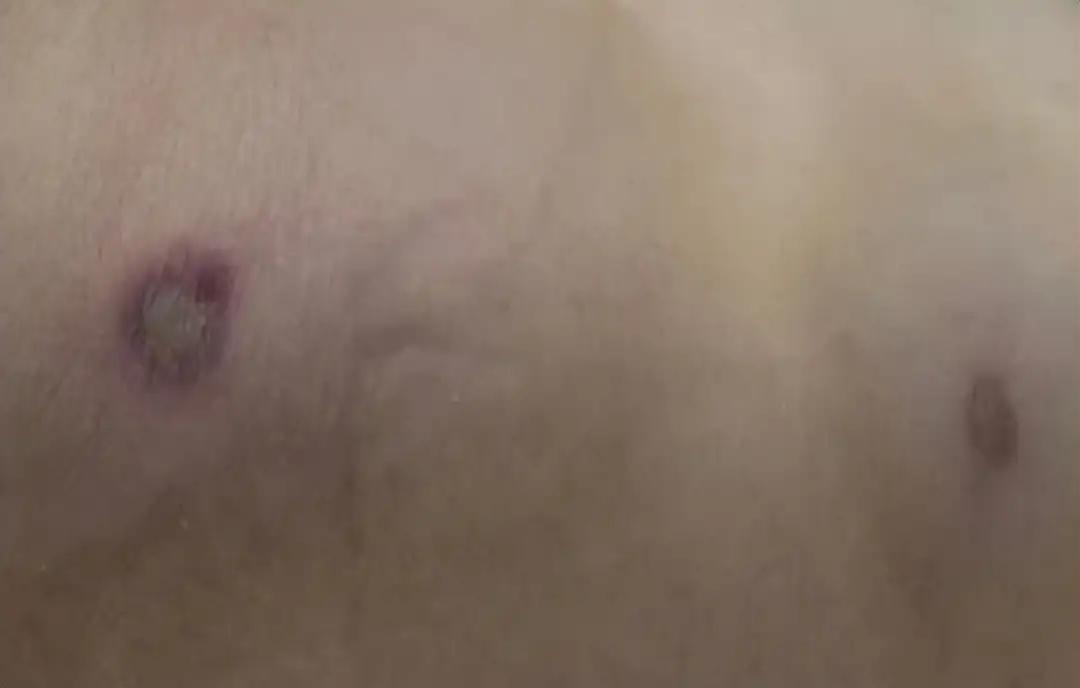 广西一夫妻遭马蜂袭击1死1伤 妻子体内八成“问题血液”被换掉。
在这场突如其来的