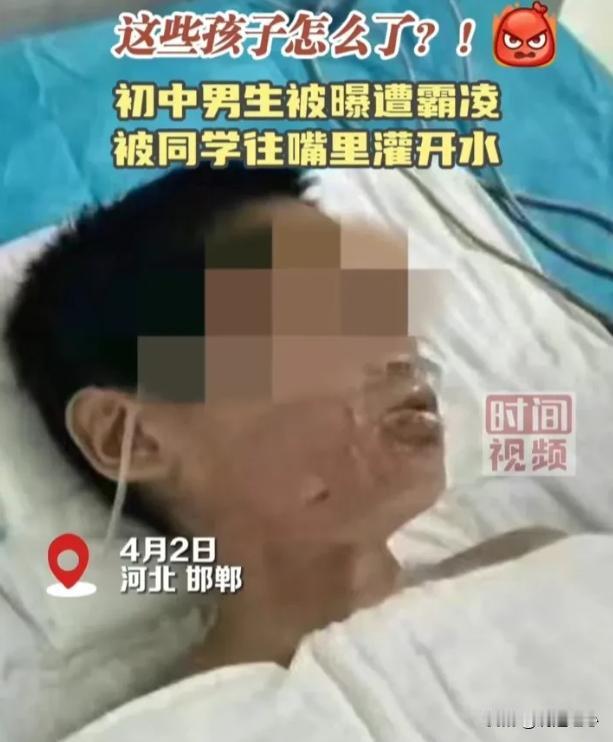 4月6日 又是邯郸，一初中生被同学往嘴里灌开水烫伤严重，官方通报来了，网友炸锅了