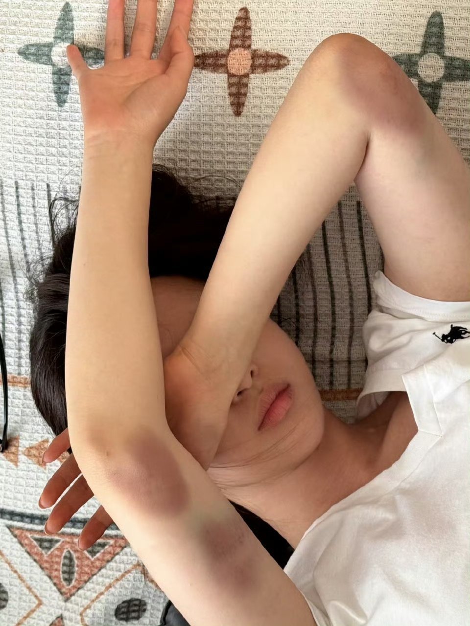 杨超越拍戏手臂大面积淤青 杨超越在《10间敢死队》拍摄时天台救蒋龙戏份时，为了达