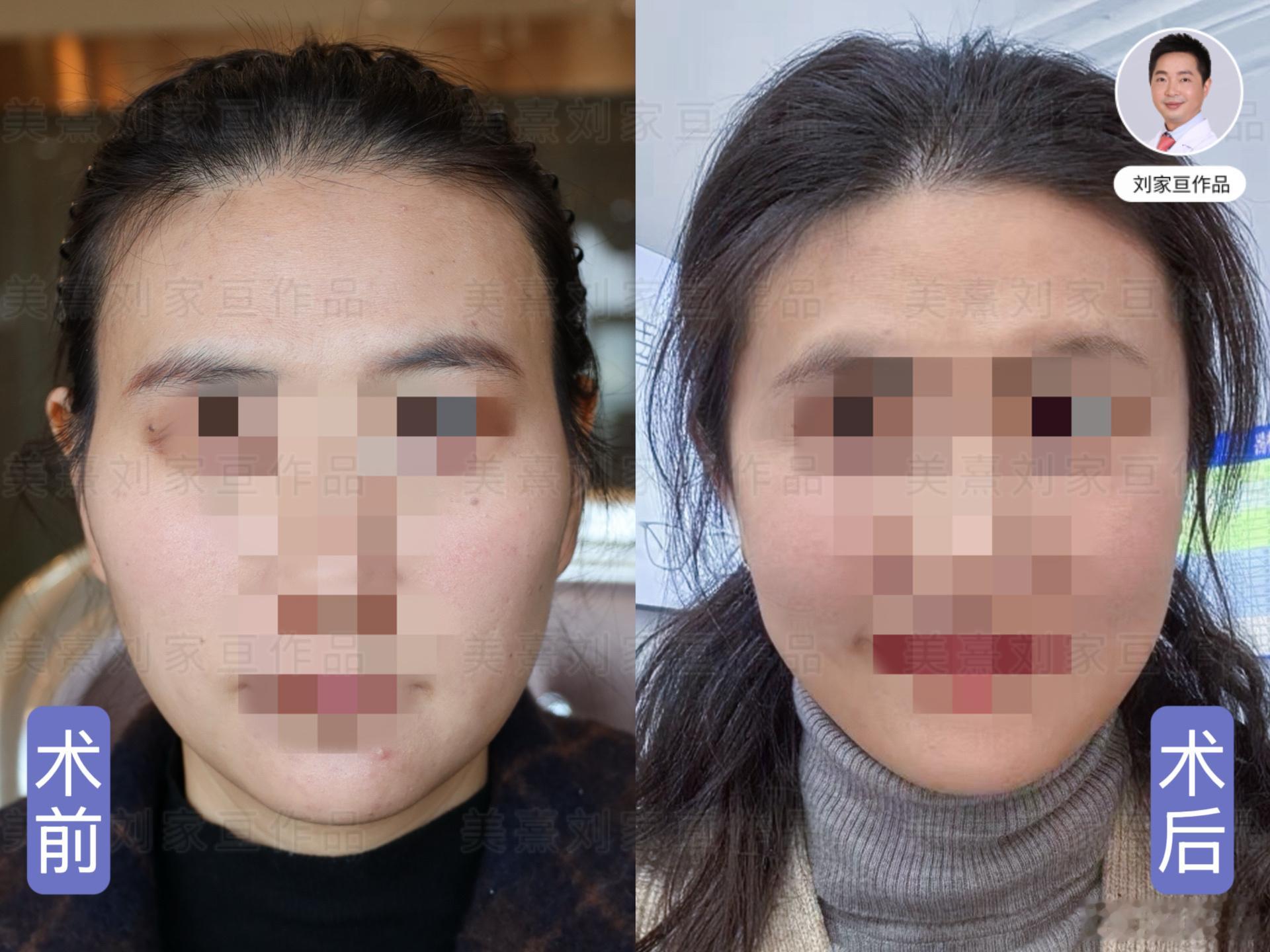 假体丰太阳穴，术后轮廓更柔和，看着更年轻了！ 