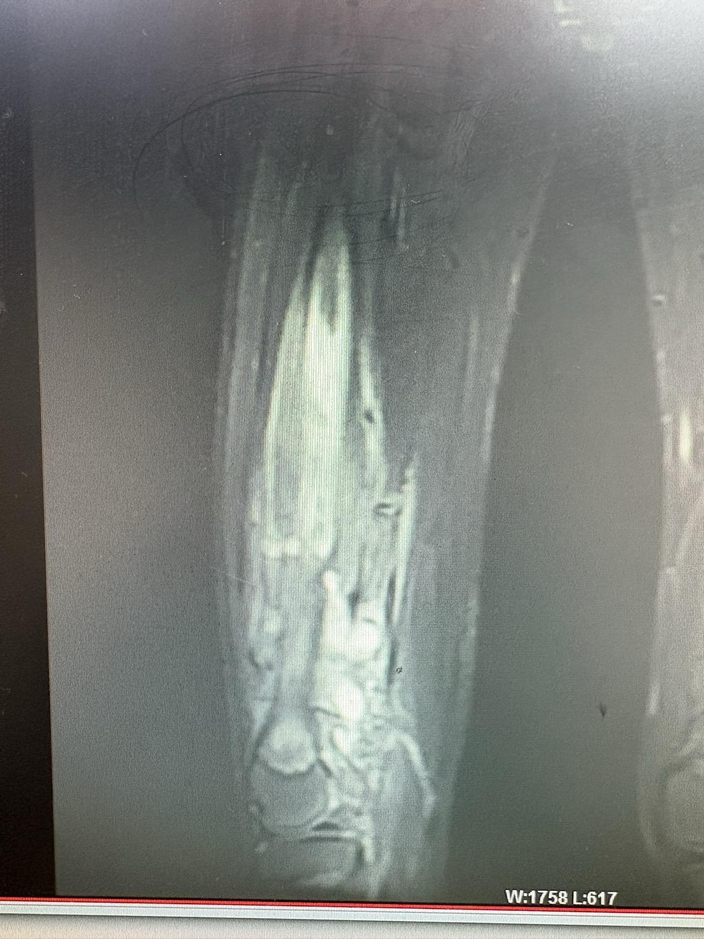 4年前慢性骨髓炎并窦道形成，术后四年复查已痊愈