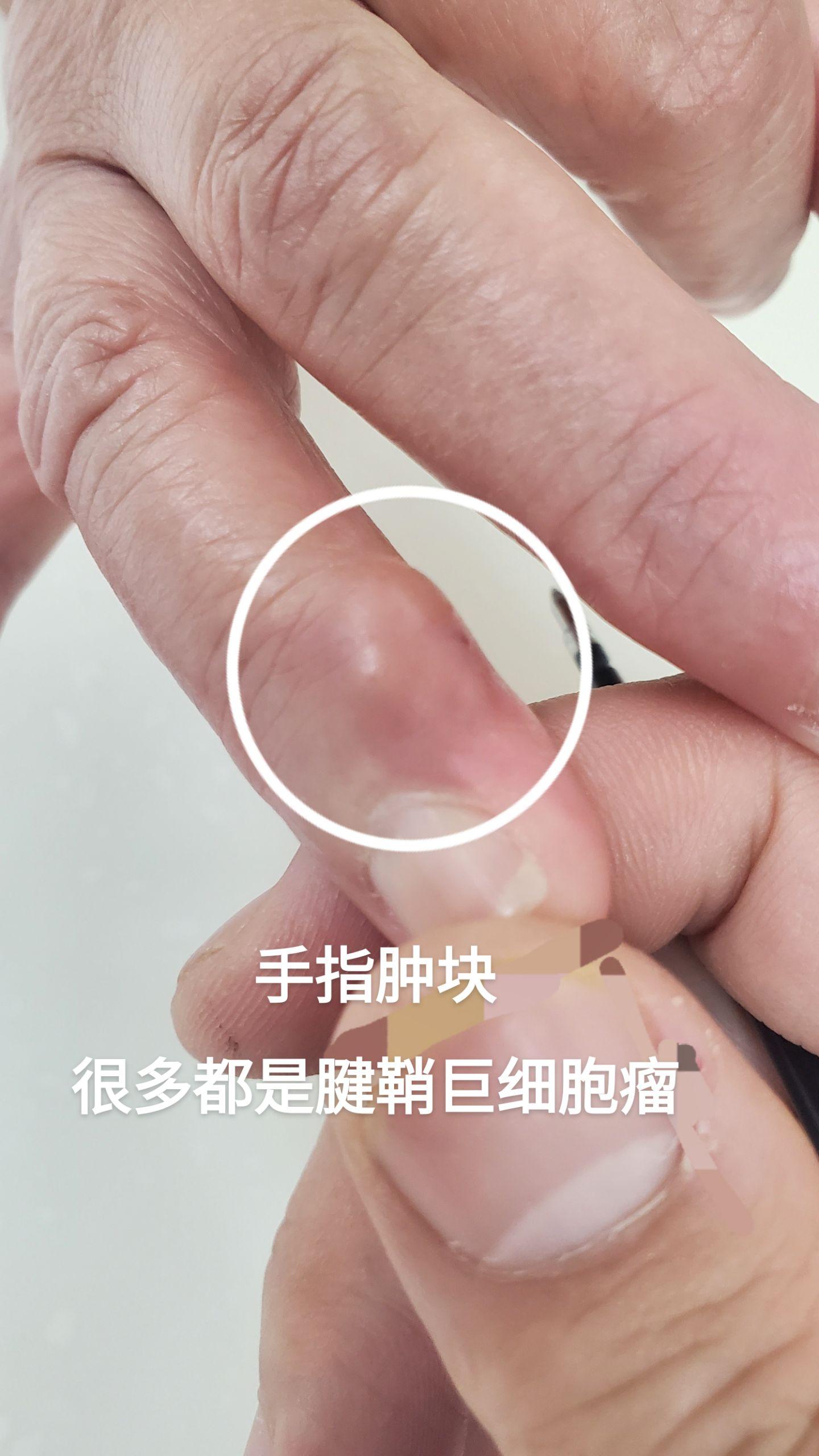 腱鞘巨细胞瘤