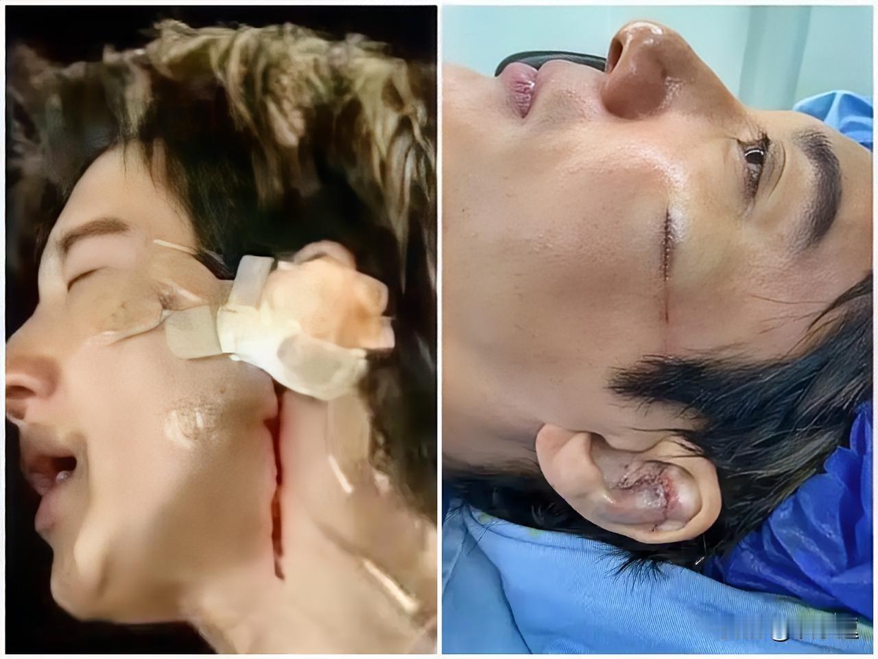 我问我学医的朋友，
王力宏缝39针脸以后会受影响吗？我朋友叹了口气说，这事还真没