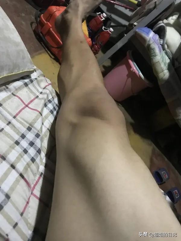 那就别走那么多，如果真肿了，
一，去医院找医生，看看是不是身体哪个器官出现了问题