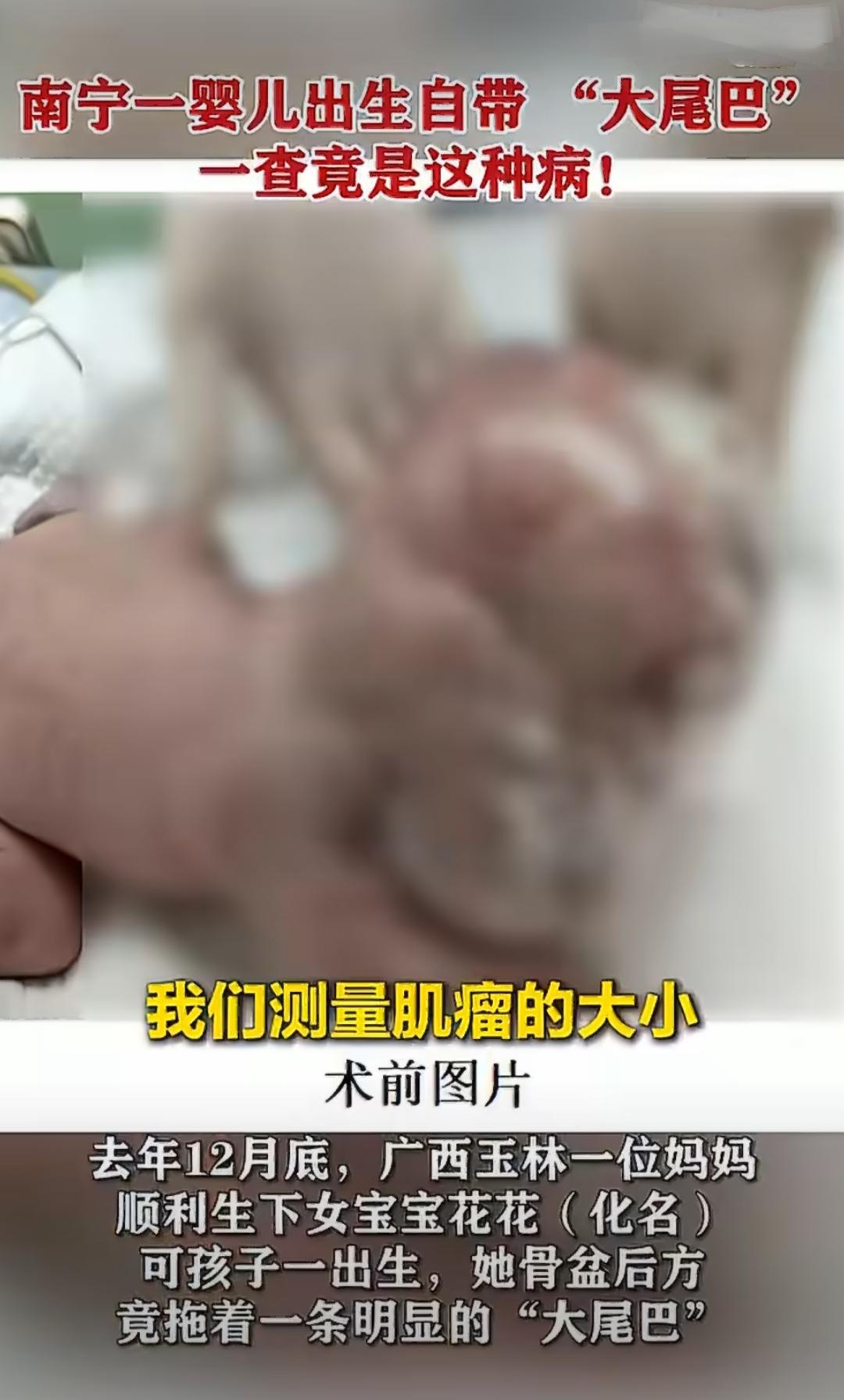 去年12月底，广西玉林一位妈妈顺利生下女宝宝花花，可孩子刚出来，家人就发现不对劲