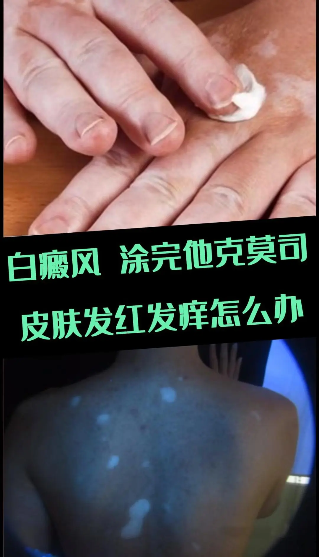 白癜风使用他克莫司后出现皮肤发痒的情况是比较常见的，以下是一些处理方法...