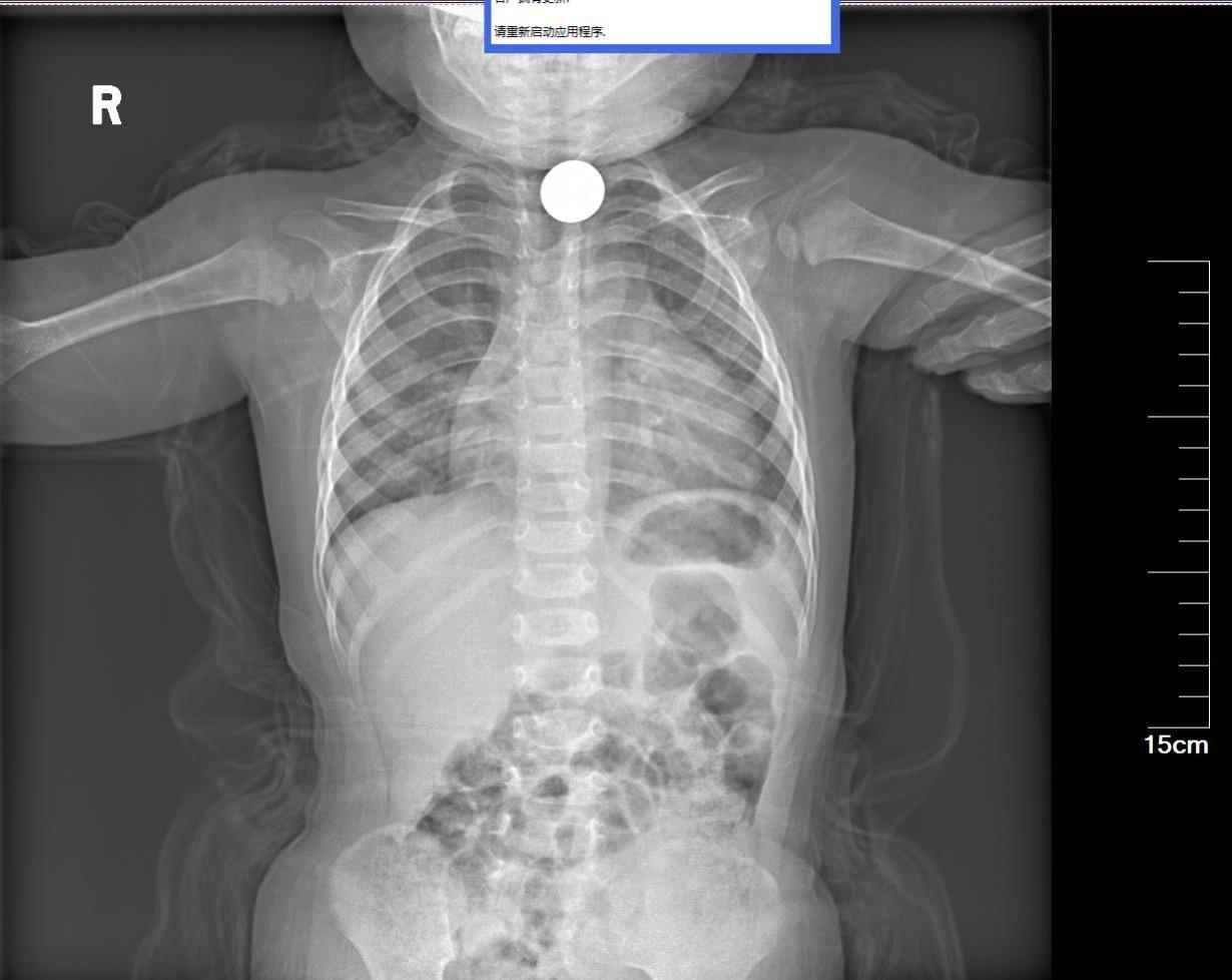 两三岁的小朋友取消化道异物到底麻醉不？个人建议能不麻醉尽量不麻醉！取异...