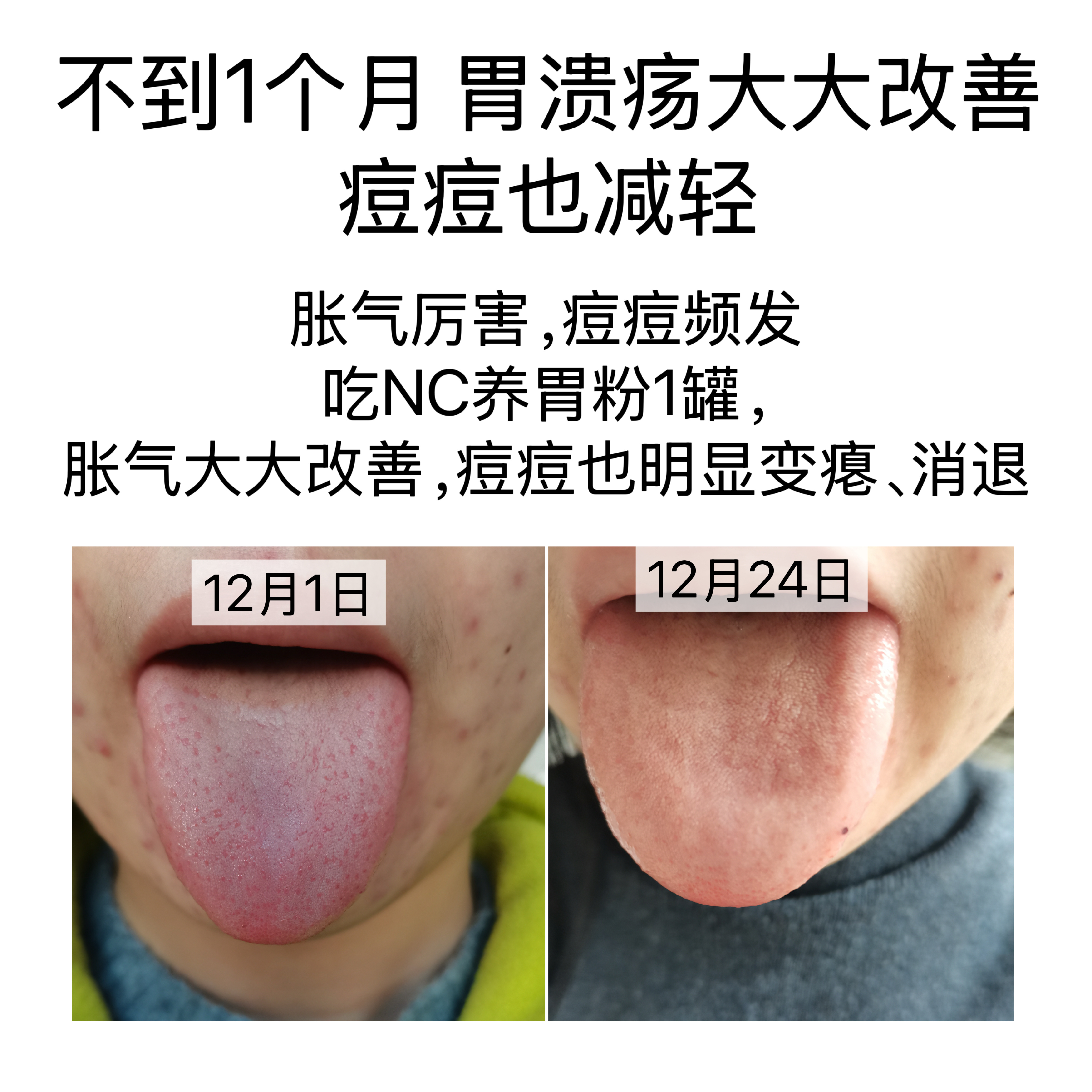 胃不好的人，容易长痘因为，胃不好的人，胃肠蠕动相对较慢，大量粪便囤积于肠道内，肠