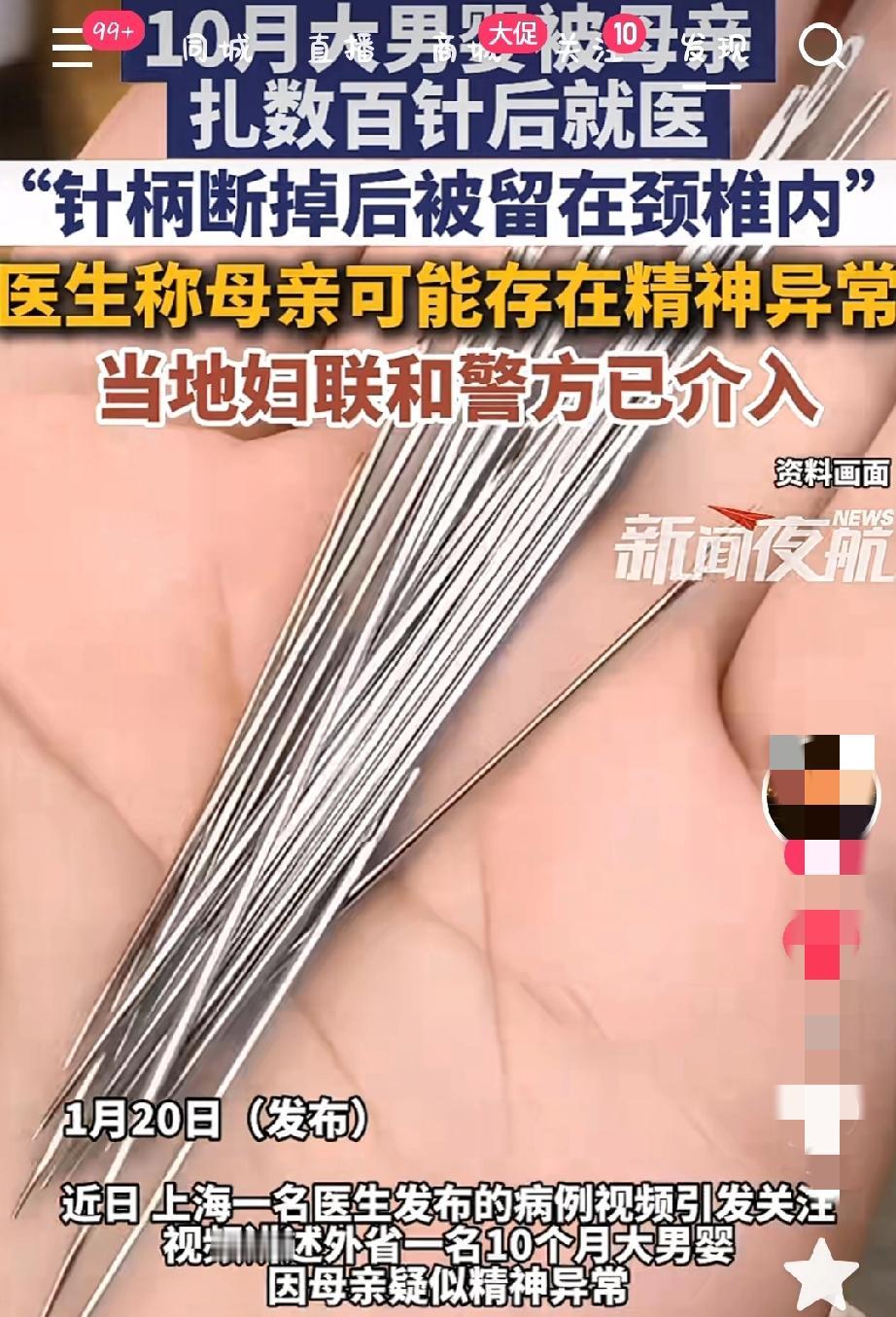震惊！10个月大的男婴竟然被自己的母亲用针全身扎了500-600个针孔！而且体内