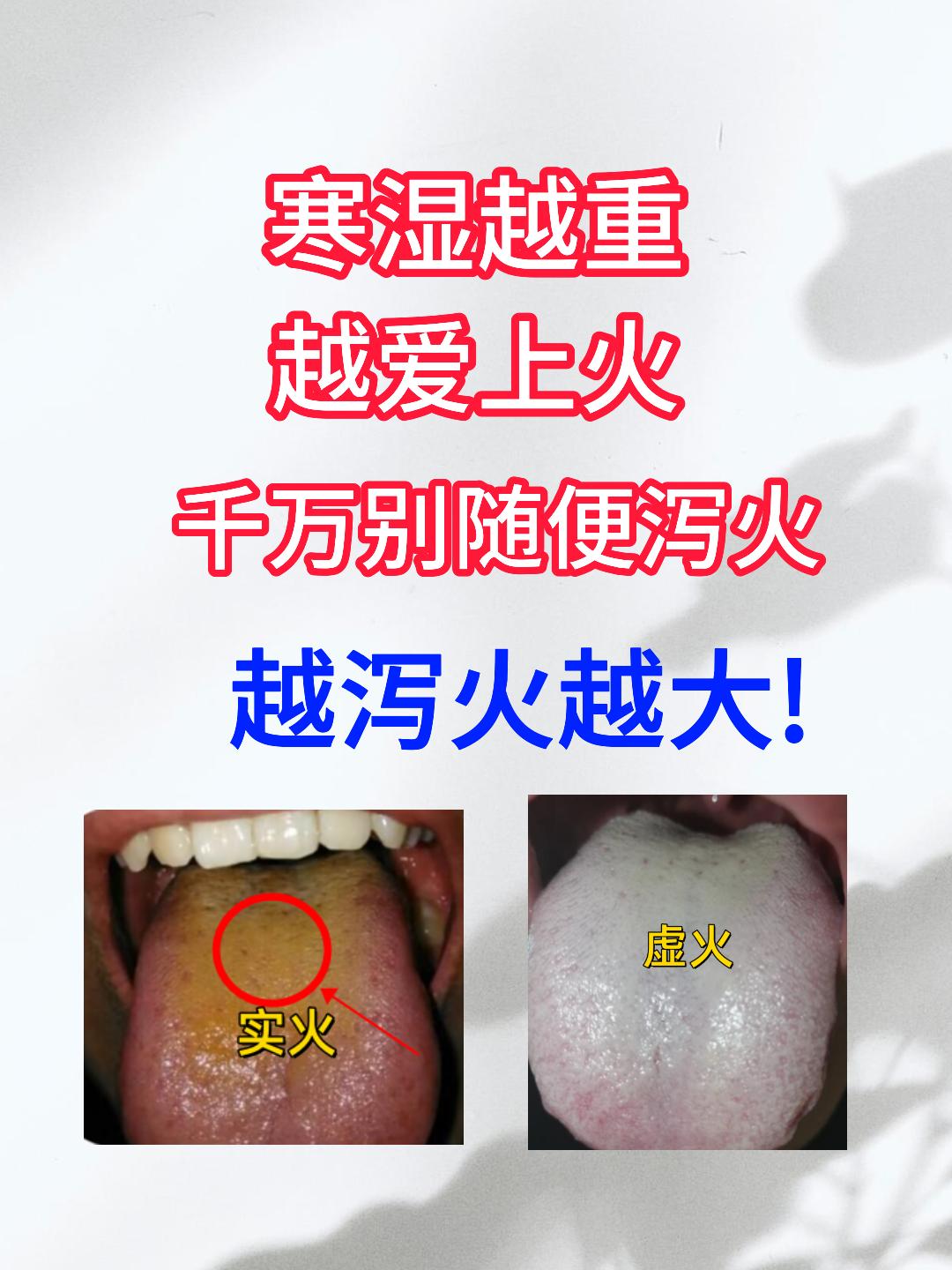寒湿越重，越爱上火？千万别随便泻火，越泻火越大！[谢谢][谢谢][谢谢]
