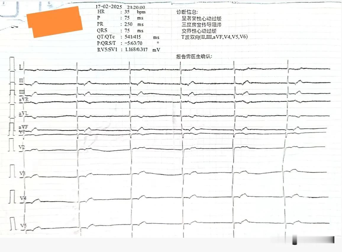 这是一位80岁的老太太因“头晕、乏力10多天”就诊时所做的心电图，为“窦性停搏、