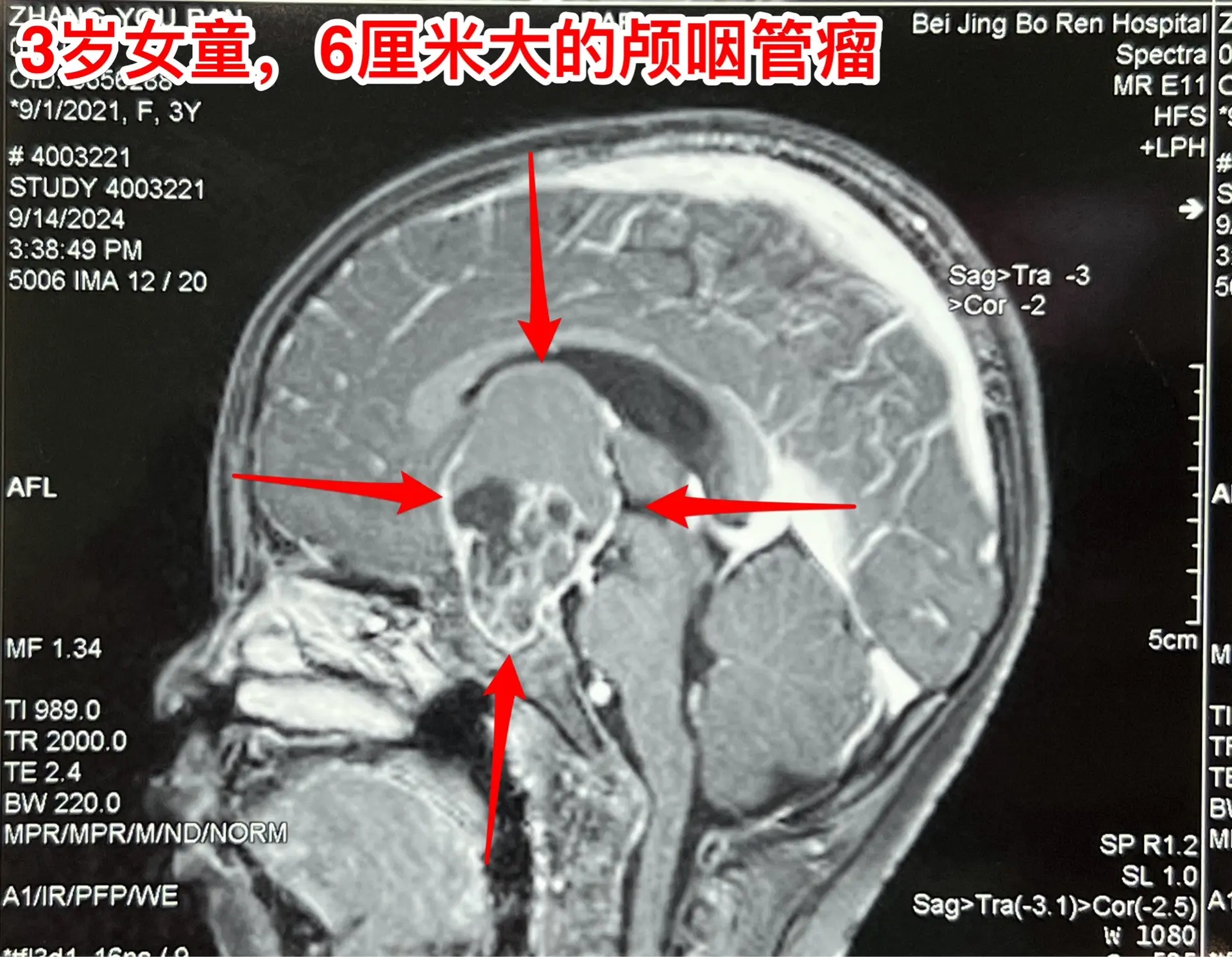 商丘市女娃患颅咽管瘤。3岁女娃，商丘市的。近一个月视力下降，家长发现她...