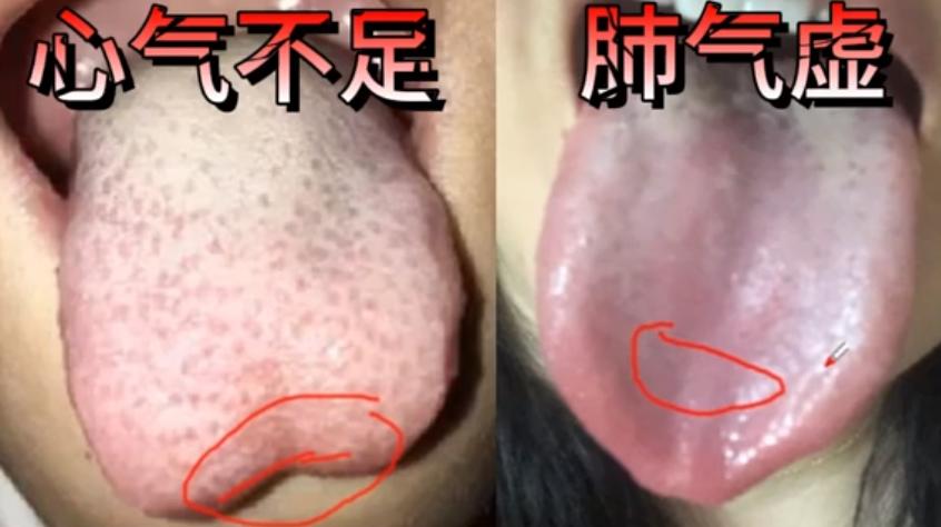 舌象分析小课堂：如何看出你是心气不足还是肺气不足？
如图所示以下是我的两位患者的
