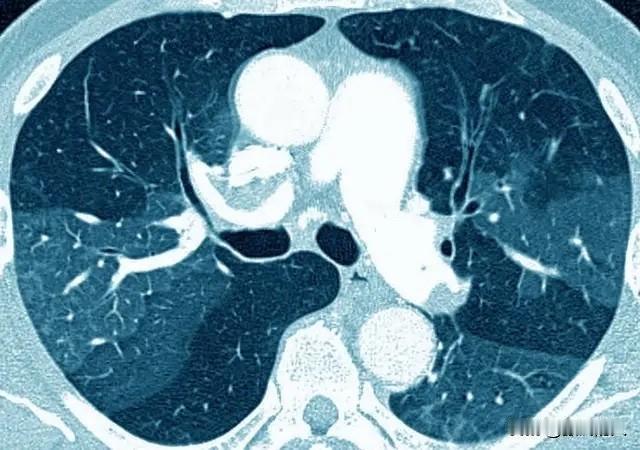 “查出5mm、8mm、15mm肺结节，到底差在哪？”

这是门诊与自媒体平台听到