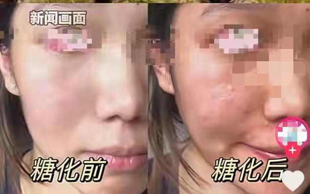 第一批奶皮子糖葫芦“受害者”现身！

   女子天天炫几串，

      脸越