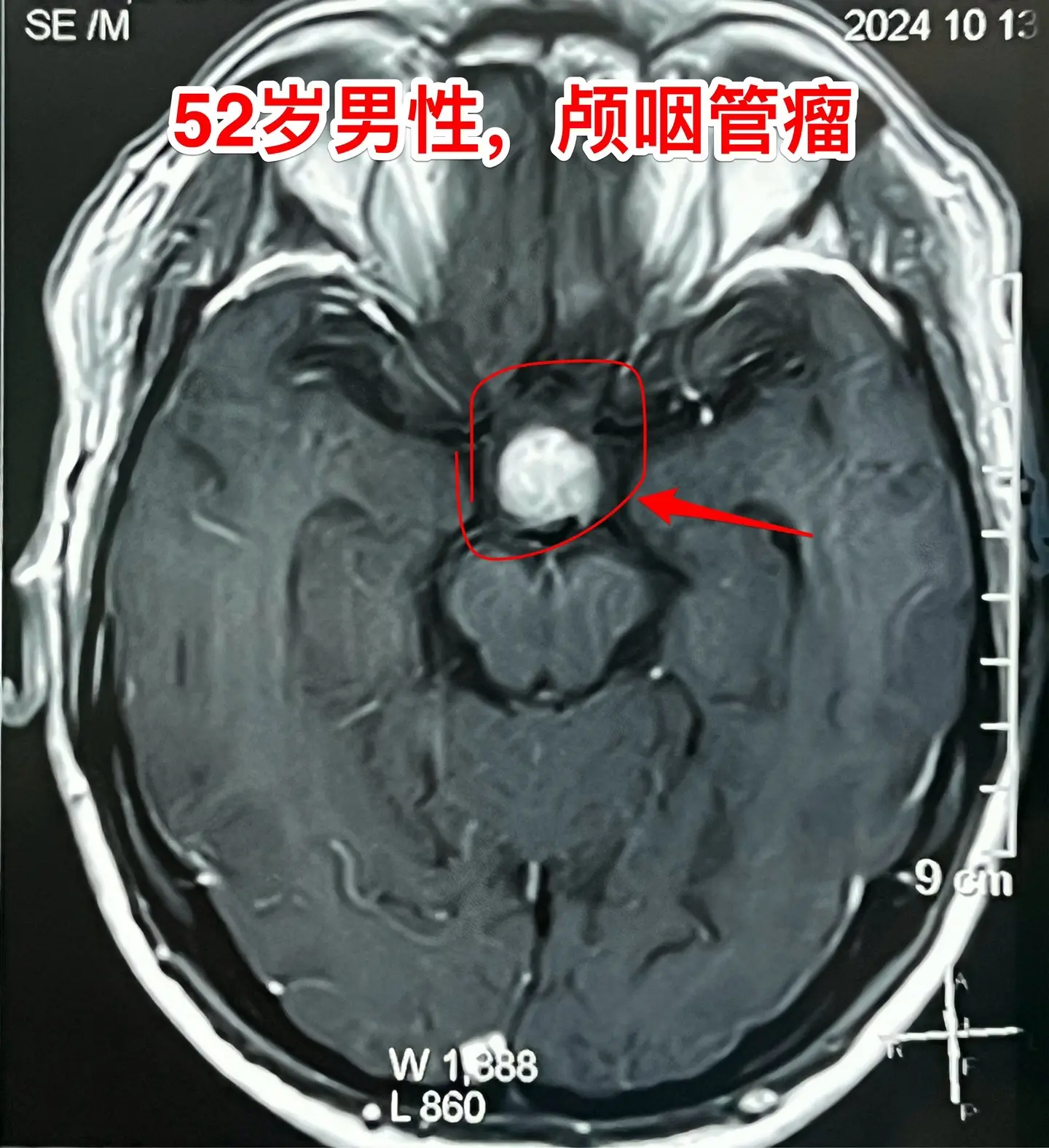 乳头型颅咽管瘤。52岁的重庆市男性，因为头痛到医院检查磁共振，居然发现...