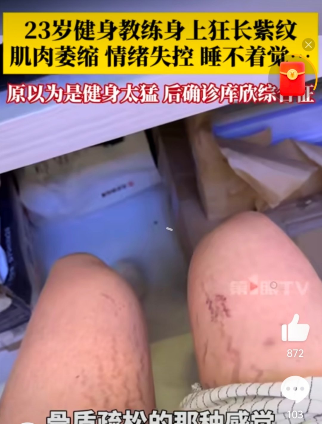23岁女健身教练身上紫纹越长越多这是什么病？和妊娠纹有点像啊！ ​​​