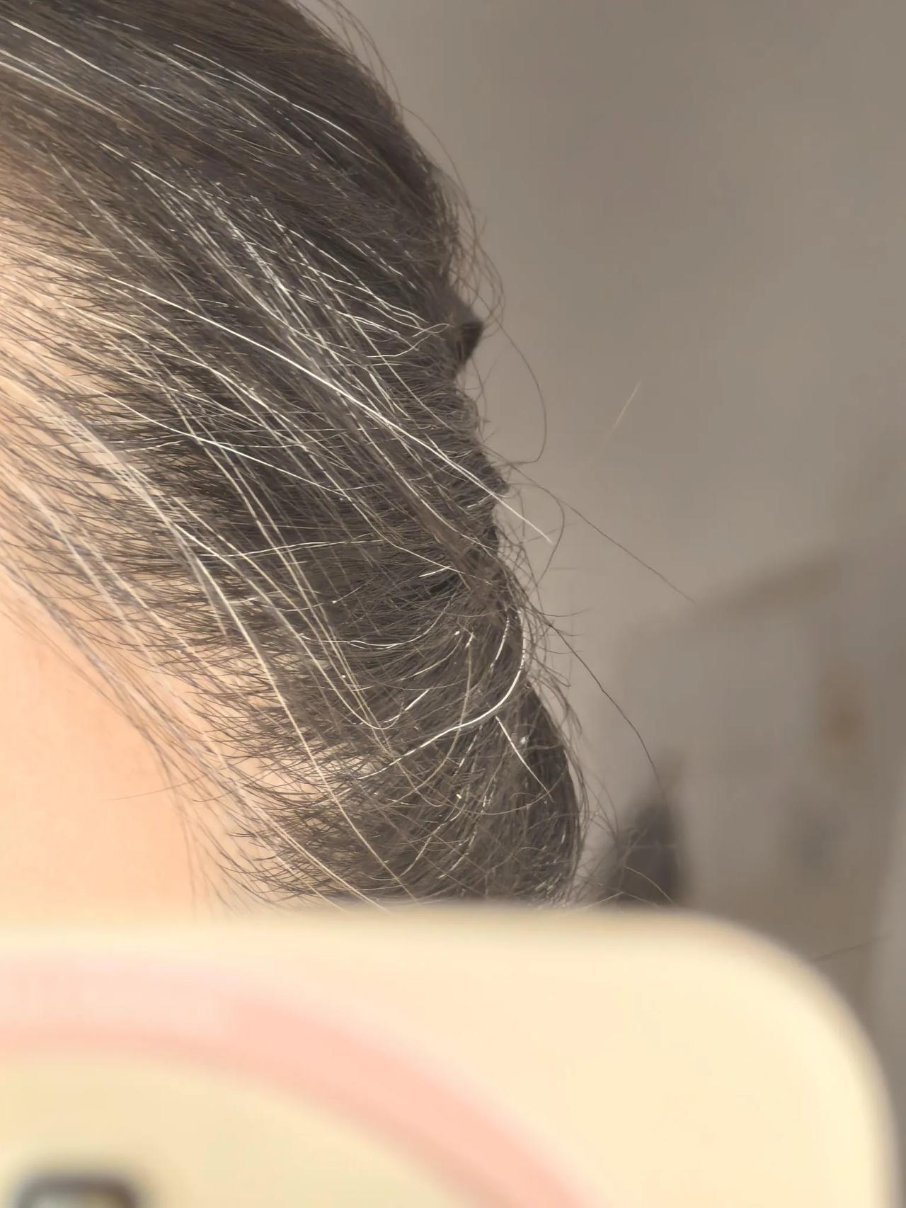 43岁，两鬓白发，正常吗？
姐妹们，83年的，已经两鬓白发了，正常吗？大家都什么