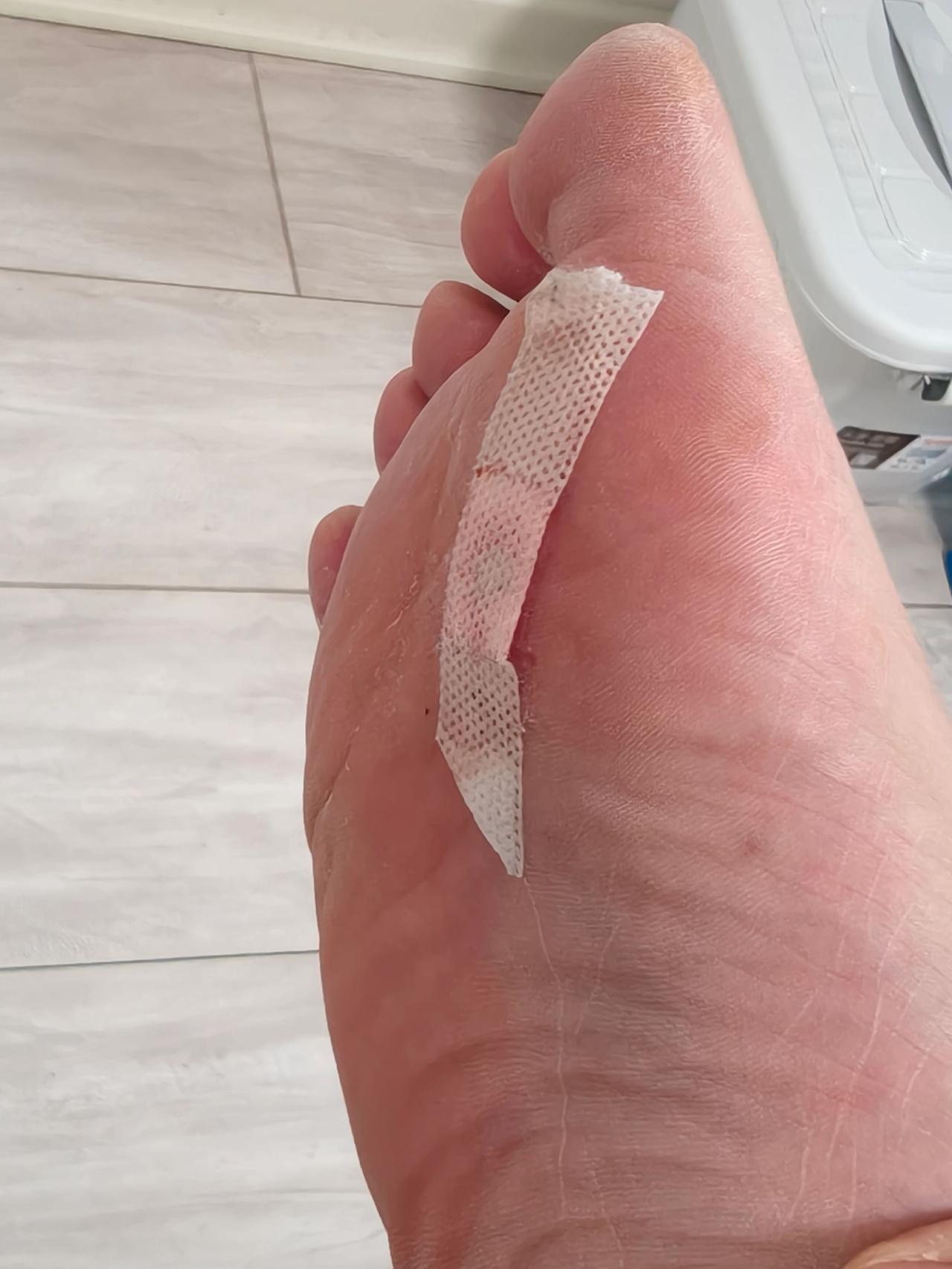 穿了某运动品牌的鞋，一天脚就捂废了。健康知识科普 医学科普健康 脚伤恢复中 足部