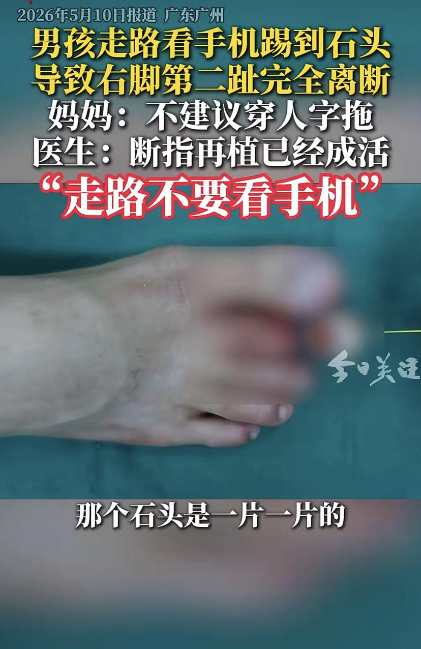16岁男孩穿人字拖看手机，一脚踢上锋利石头，脚趾当场断了!
广东广州一个16岁男