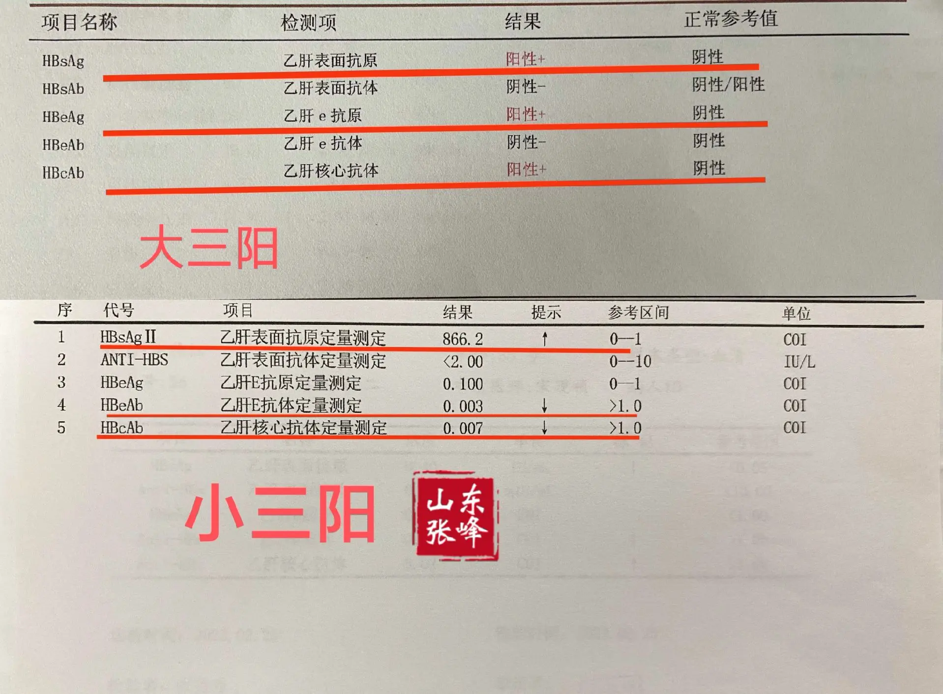 乙肝大三阳VS小三阳哪个更严重？乙肝大三阳和小三阳是乙肝病毒感染后的两...