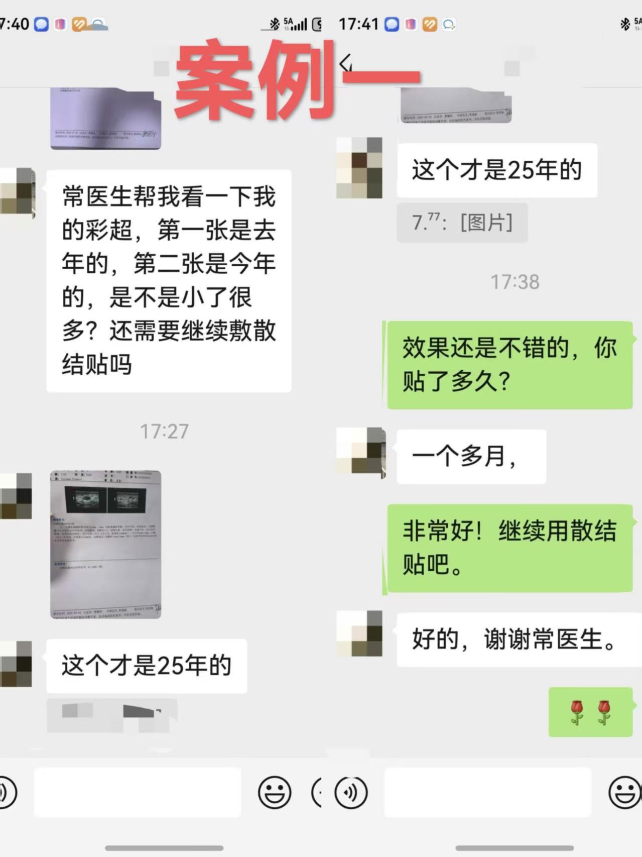分享两个使用“乳痛散结贴”的案例:一个是乳腺增生合并囊肿，使用一个多月，增生疼痛