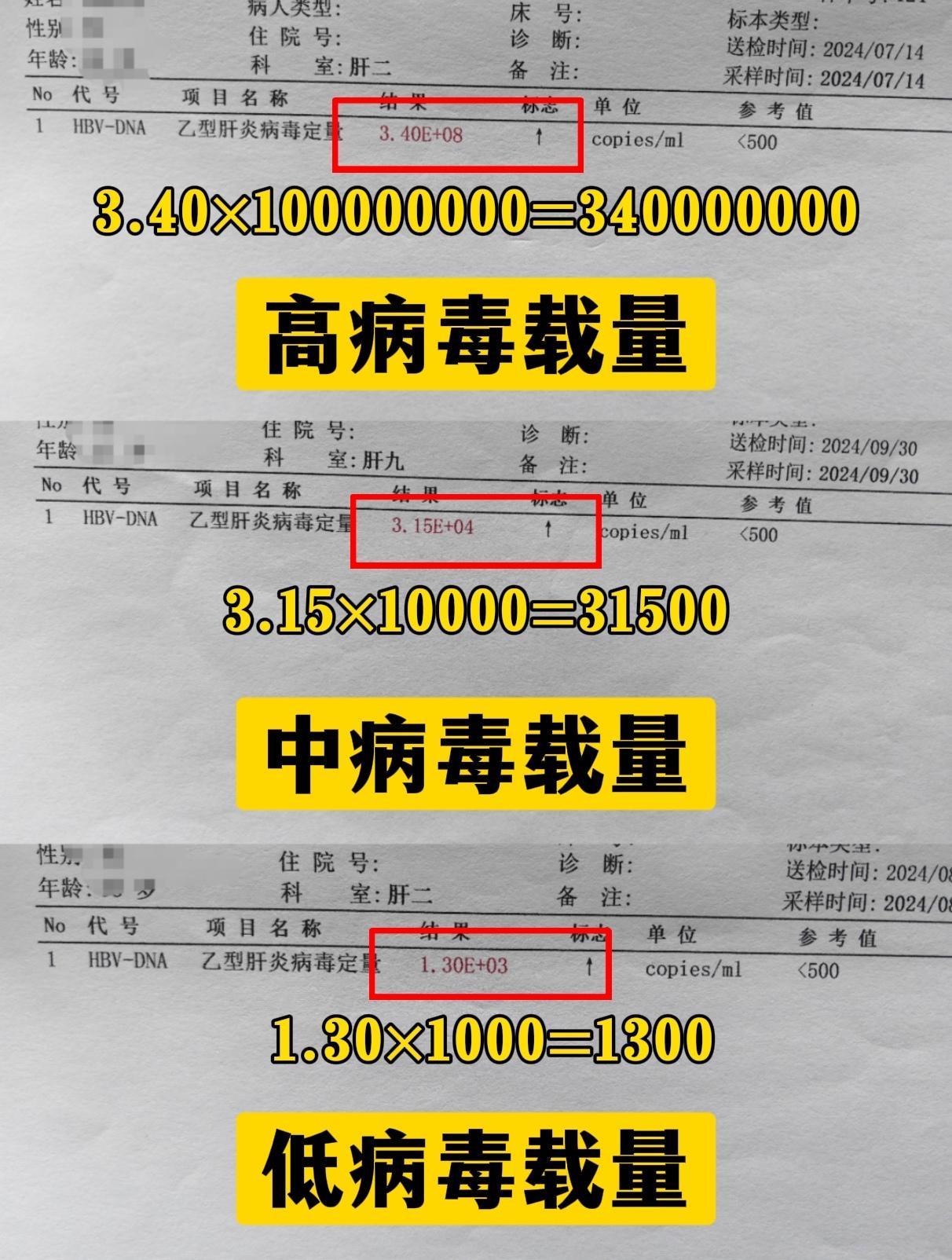 ①高病毒载量:大于10的6次方，这意味着血液中的乙肝病毒数量非常高,传...