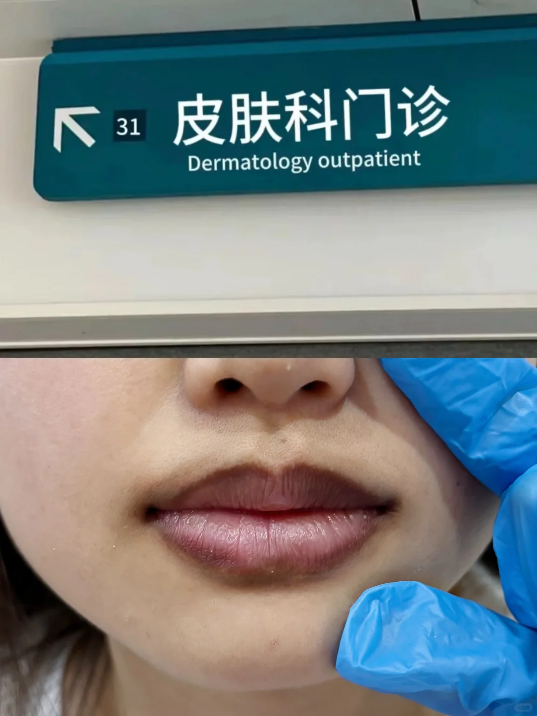 去了趟皮肤科，从此唇周黑远离我...