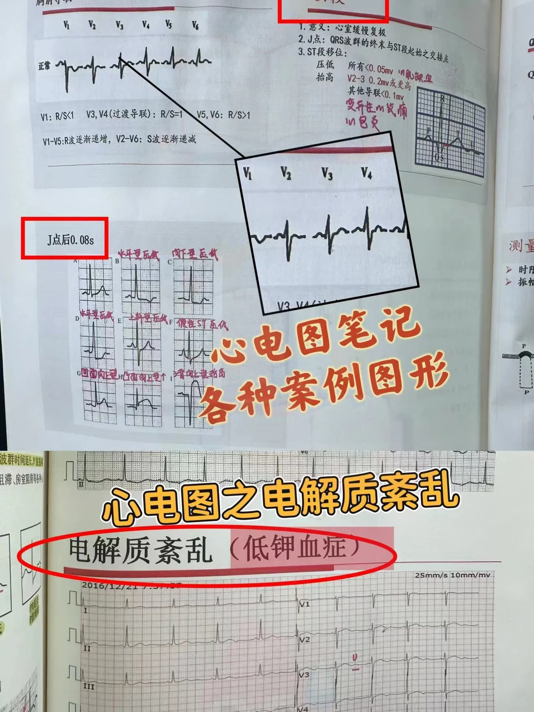 规培医学生心电图笔记、心电图夜班值班
