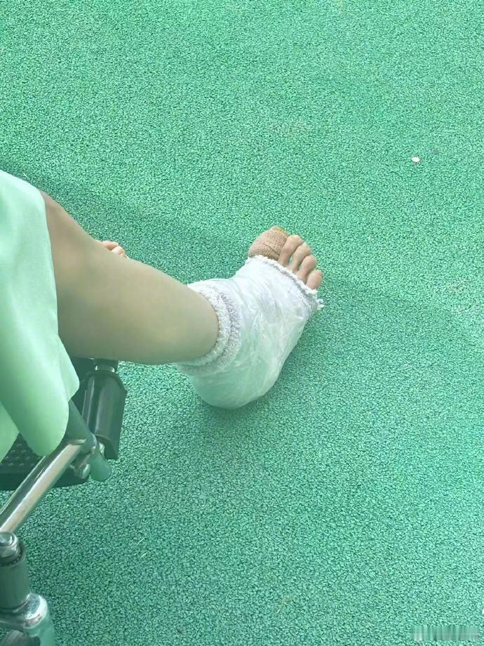 #张雨绮拍戏脚受伤了#哎呀，姐姐拍戏的时候穿露脚趾的鞋，脚受伤了，拔了一个指甲盖