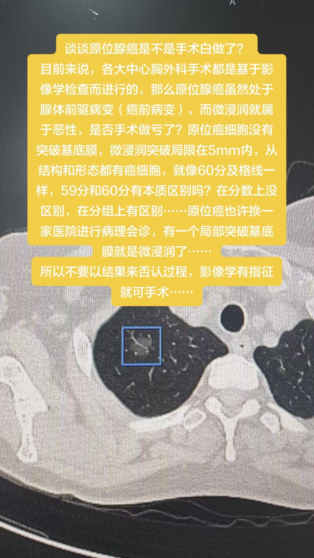 谈谈原位腺癌是不是手术白做了？谈谈原位腺癌是不是手术白做了？ 目前来说...