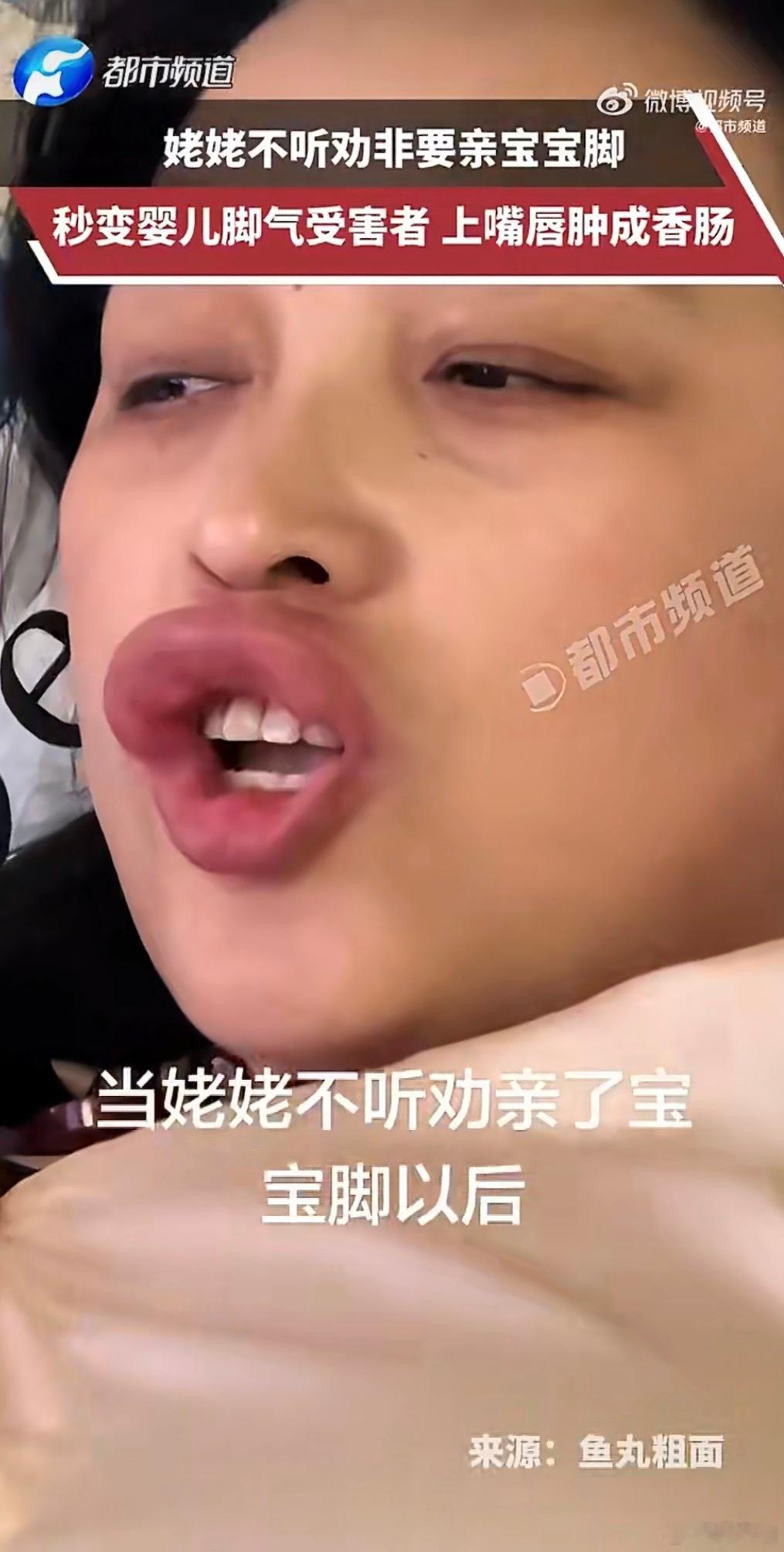 女子亲宝宝脚丫嘴唇肿成香肠女子亲吻宝宝脚丫后，嘴唇突发严重肿胀成香肠嘴，诱因是宝