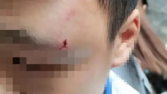 初二的学生被老师的丈夫用螺丝刀刺伤！起因是因为课堂争执，当时，这名学生在课堂上与