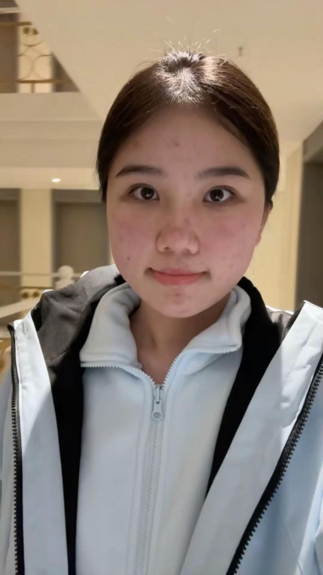 长痘是少女时代连绵不断的雨季 迷恋好皮肤是少女时期走不出的淤泥