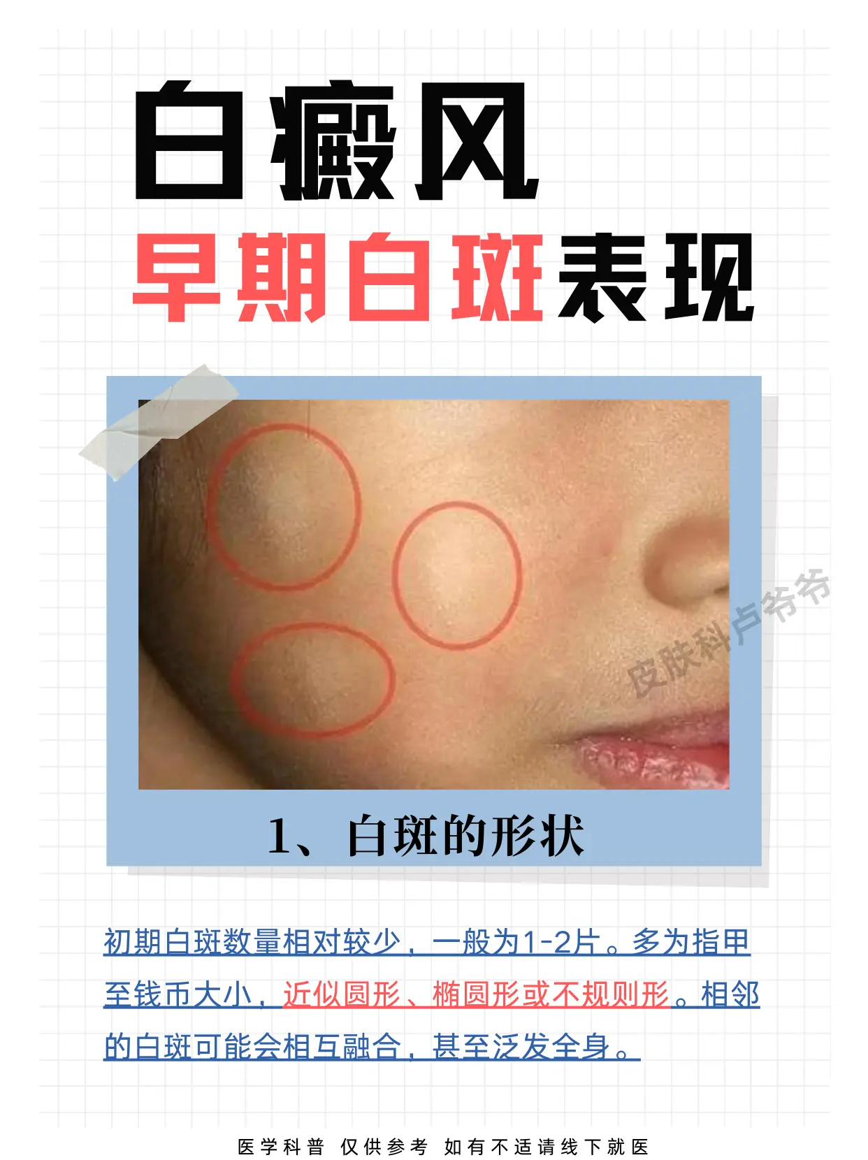 白癜风的早期症状表现