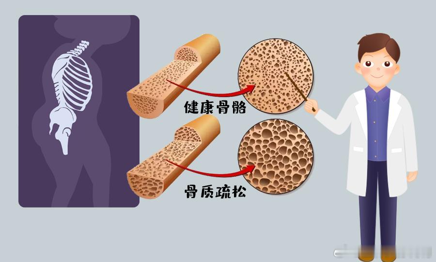 #这个问题吃什么##健闻登顶计划# 【骨质疏松患者不宜运动？】保持正常的骨密度和