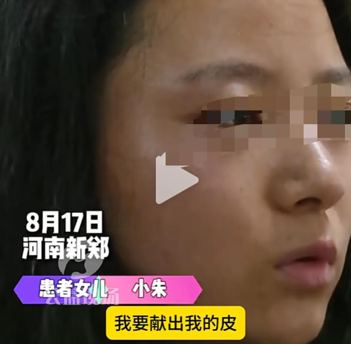 近日，河南煤气突爆炸，母亲被烧伤，急需植皮救命！女孩：我要献出我的皮，来帮助我的