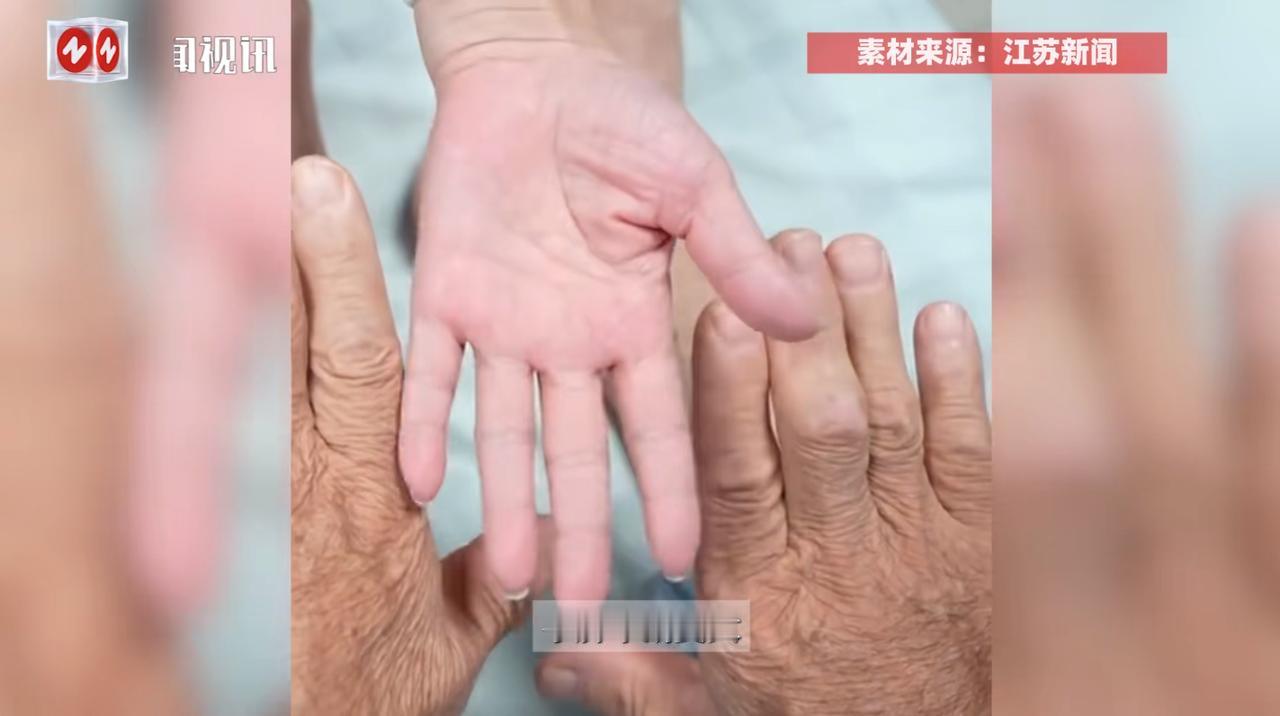 “活久见！”广东，一位67岁的大爷突然开始“二度发育”，鞋码从42涨到45之后还