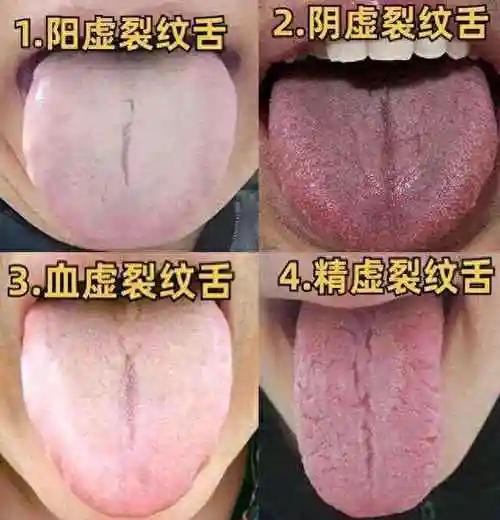 一、舌象辨证：跳出 “脾虚” 误区，认准 “肝火 + 湿热” 信号
消化、上火问