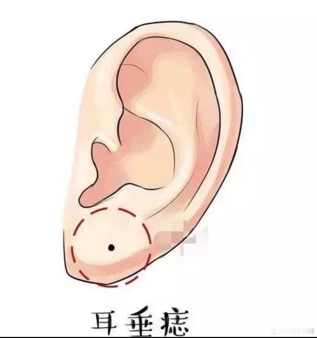 耳上有痣的人，很有福气耳朵上方有痣的人才华横溢，能把握幸运，事业会比较容易成功，