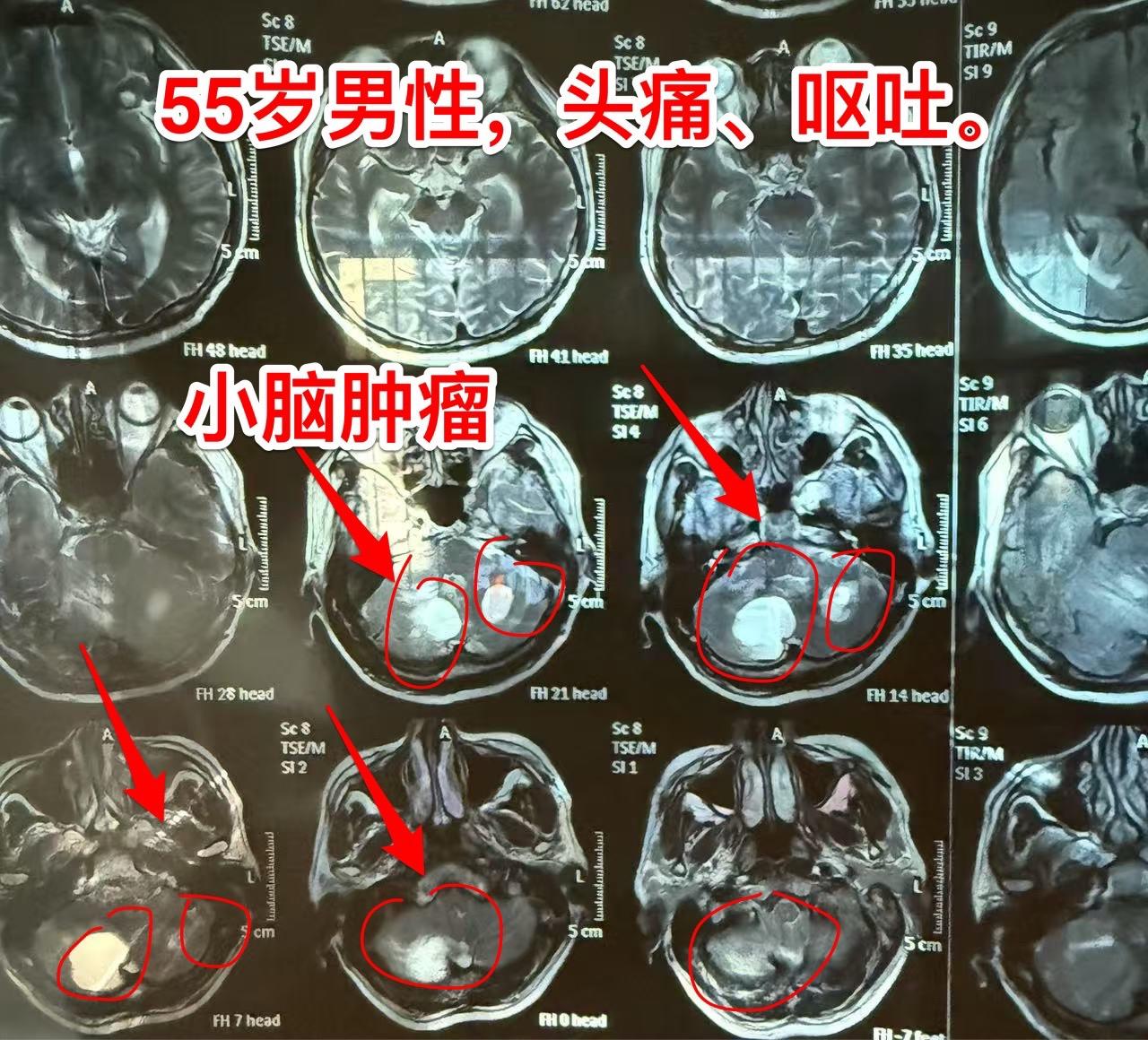 55岁男性头痛、呕吐，为啥还要检查肺？55岁男性，黑龙江省富裕县人，近...