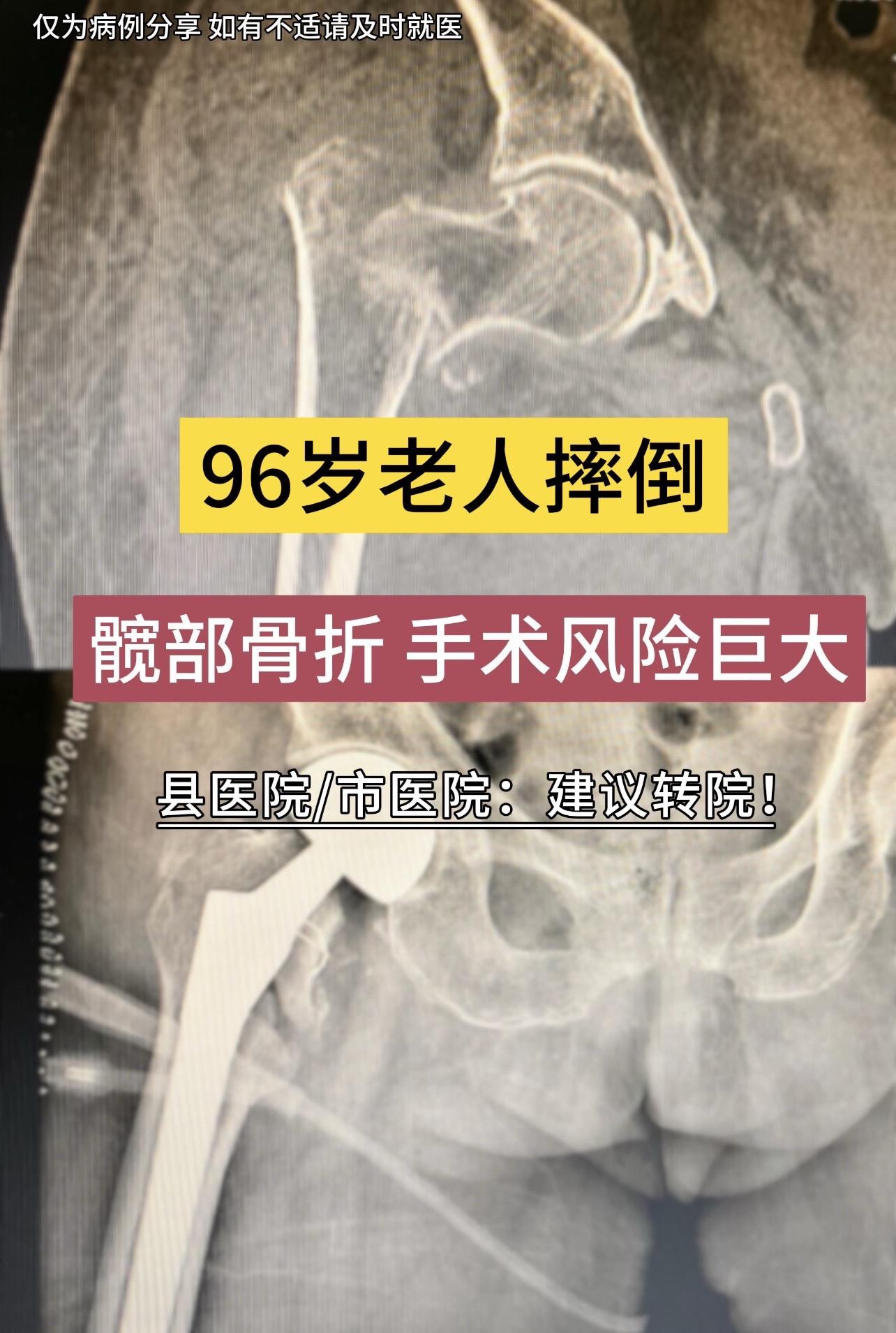 96岁老人，摔倒髋部骨折，手术风险巨大，县医院市医院建议转院。入院后检...