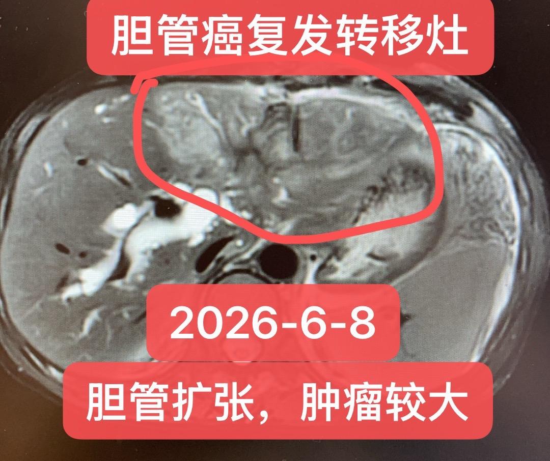 胆管癌的复发转移补救。患者男，38岁，因为黄疸1周，完善检查考虑胆管肿...