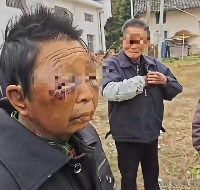 湖南，一女子多次遭受丈夫的殴打，每次都被打的鼻青脸肿。女子前往医院治疗之后，回到