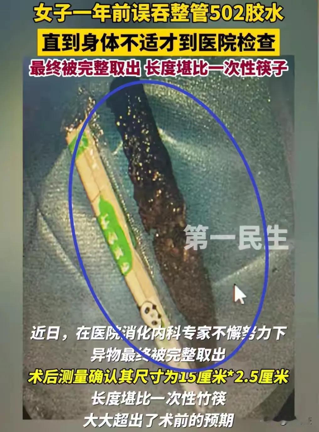 在海南三亚发生的一起不寻常的医疗案例，一位刘姓女子一年前不慎吞下了整管的502胶