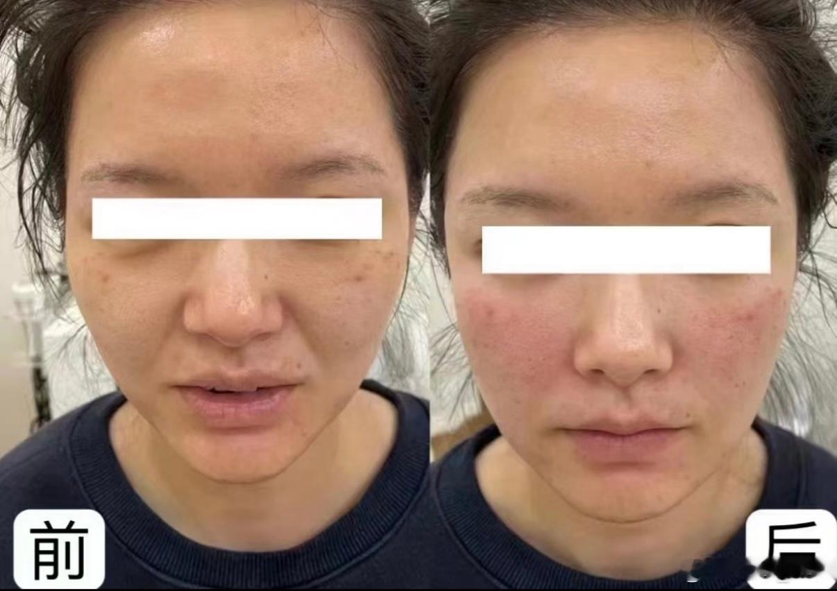 ▫️一代美拉美基础聚焦超声模式，多探头覆盖不同皮肤层次，主打轮廓收紧。▫️美拉美