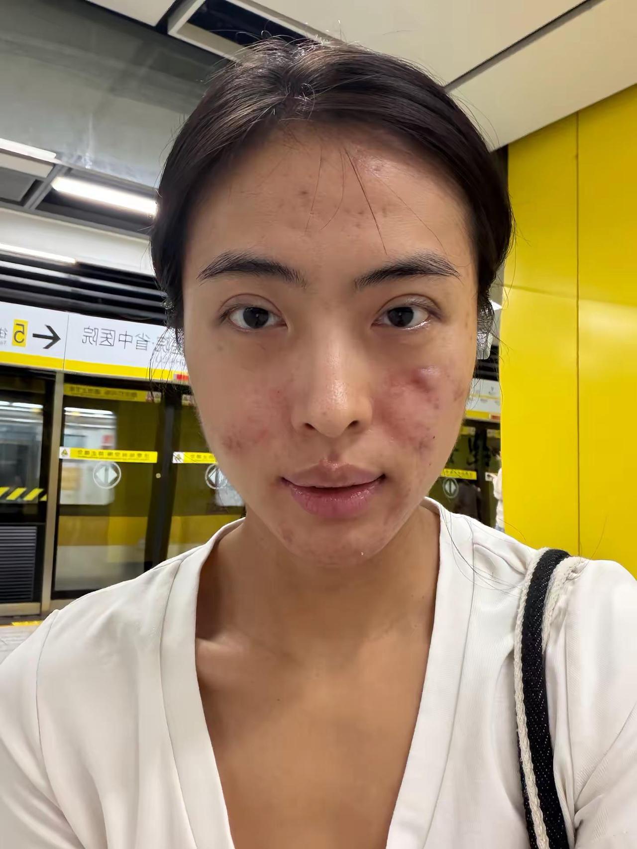 九月 请给姐一点好运今天是个好日子 微创 痘痘消除术 如何拯救痘痘肌