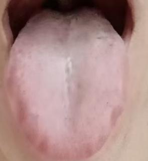 舌红少苔小便不利，详解男科虚实夹杂调理之法







前几天有位男粉丝跟我倾